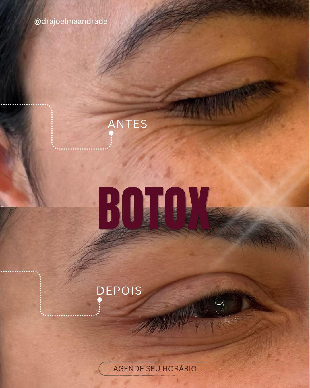 Preenchimento Labial